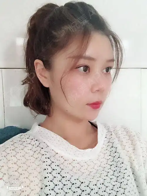 俗话说一张白纸好作画脂肪填充之后不知道是不是我的...面部填充悦美整形
