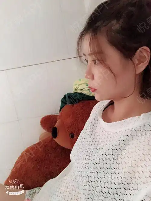 俗话说一张白纸好作画脂肪填充之后不知道是不是我的...面部填充悦美整形
